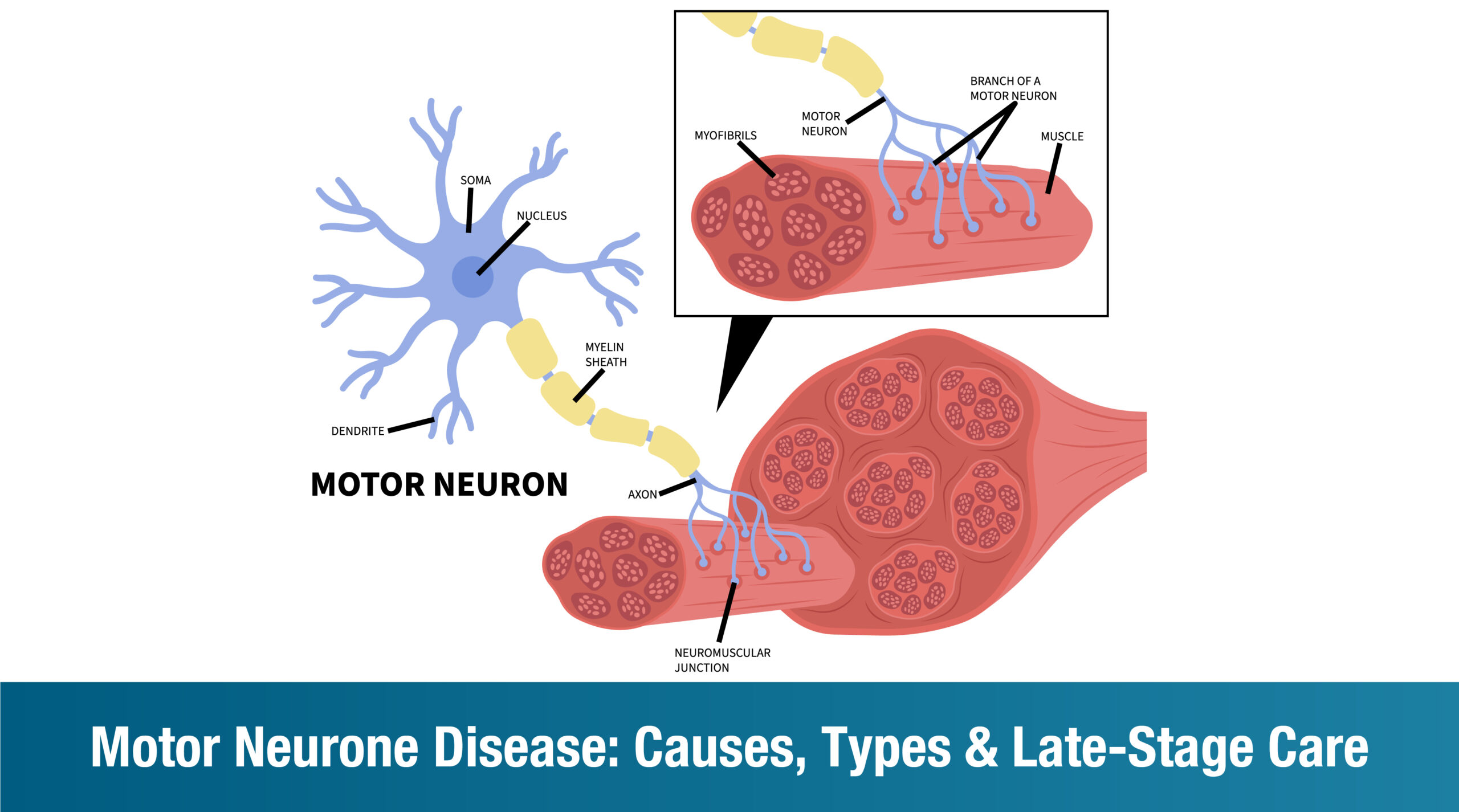 Understanding Motor Neurone Disease: Causes, Types, and How to Manage the Later Stages