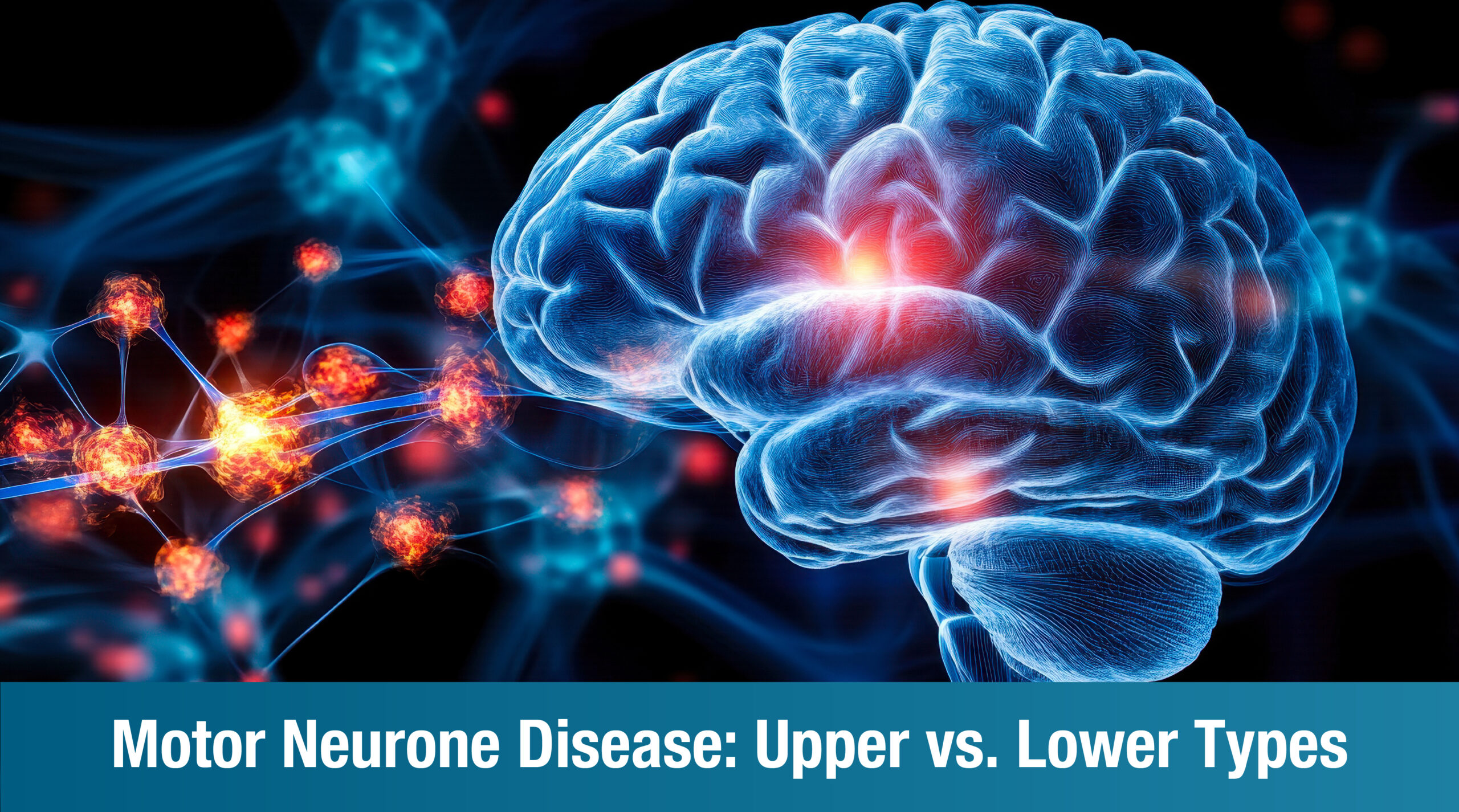 Types of Motor Neurone Disease: Understanding Upper vs. Lower Motor Neuron Disease