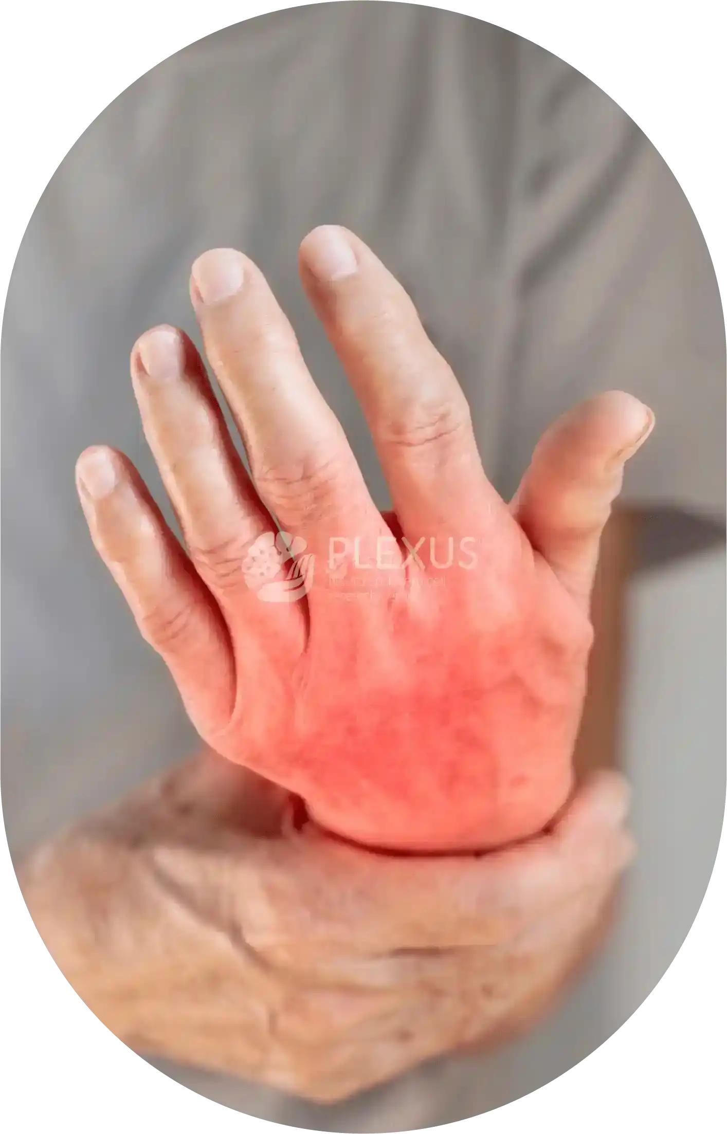 Rheumatoid arthriti