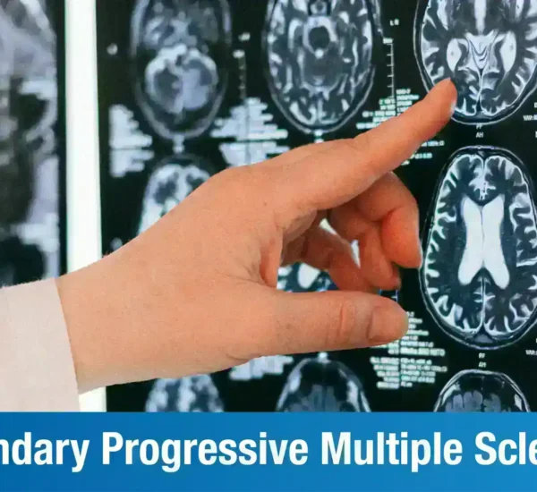 Secondary Progressive Multiple Sclerosis: Causes, Symptoms & Treatment