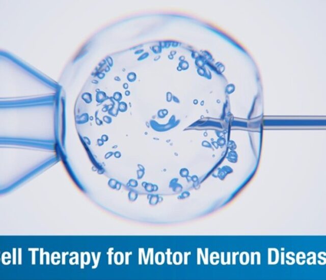 Cell Therapy for Motor Neuron Disease: Procedure, Benefits, and Success Rate