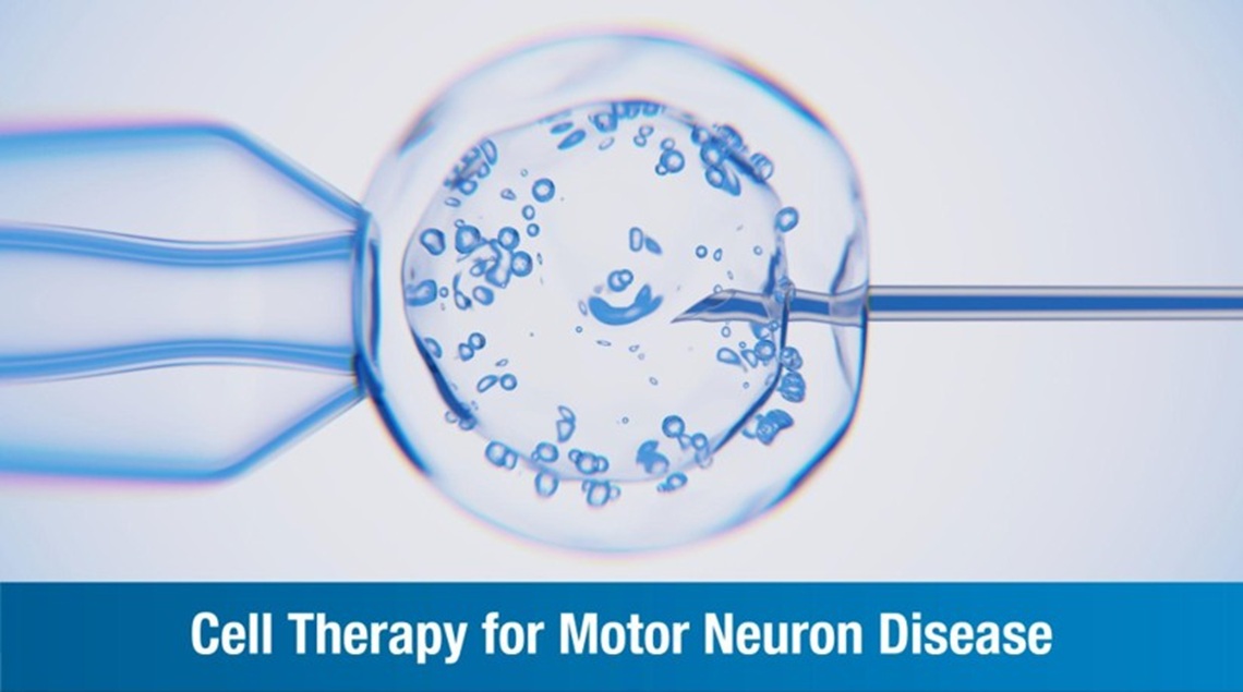 Cell Therapy for Motor Neuron Disease: Procedure, Benefits, and Success Rate