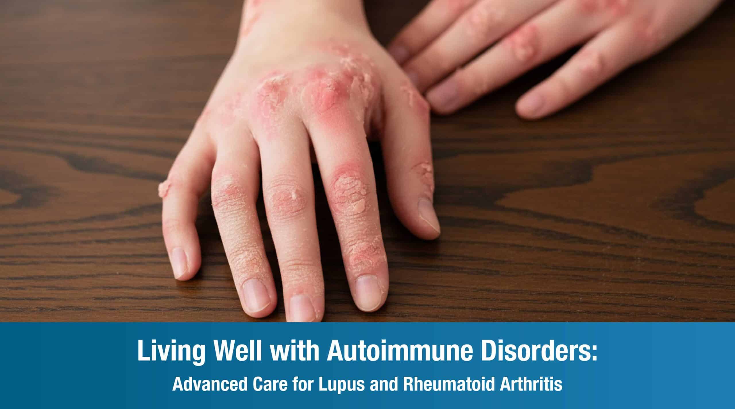 Living Well with Autoimmune Disorders:  Advanced Care for Lupus and Rheumatoid Arthritis