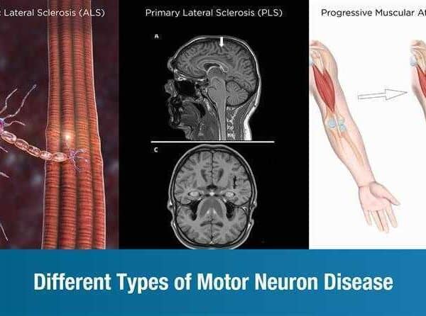 Different Types of Motor Neuron Disease