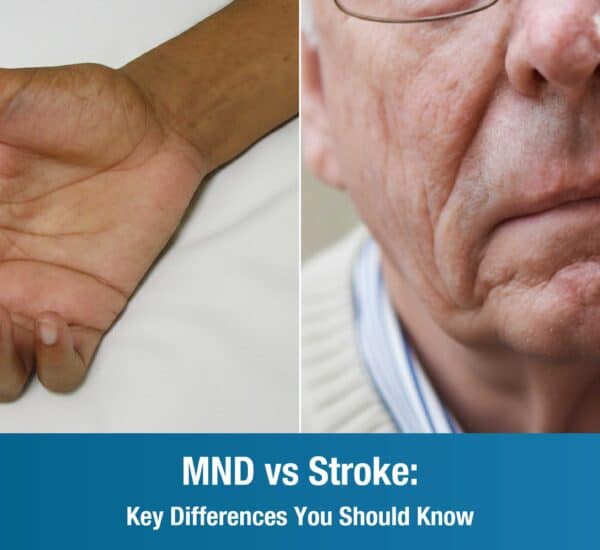 MND vs Stroke: Key Differences You Should Know