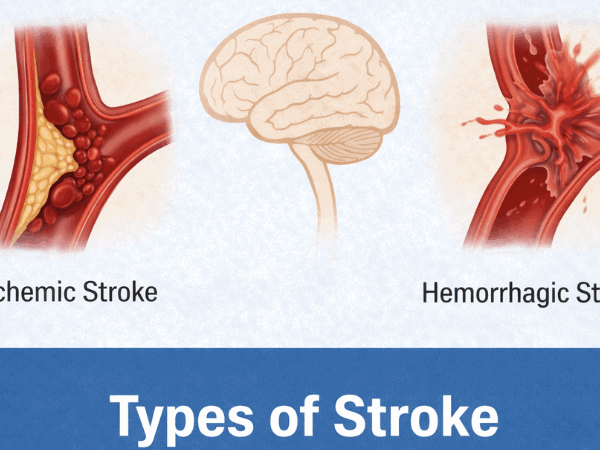 Types of Stroke: Ischemic & Hemorrhagic